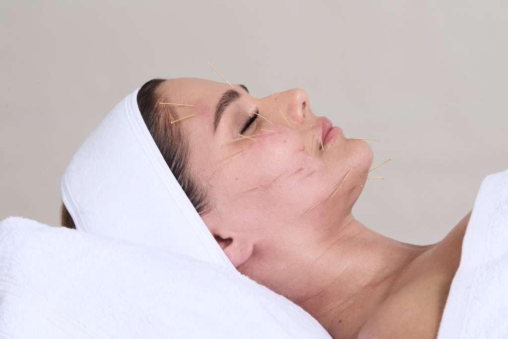 Close-up of fine acupuncture needles precisely placed along the face during an Acuskinlift treatment